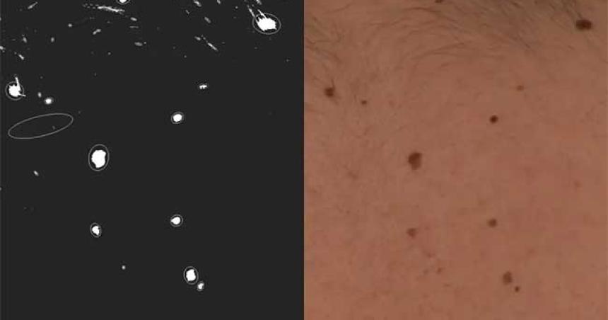 El software que detecta el caacutencer de piel comparando lunares con estrellas