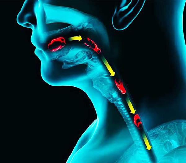 Cómo saber si tengo Disfagia? Síntomas, causas y tratamiento