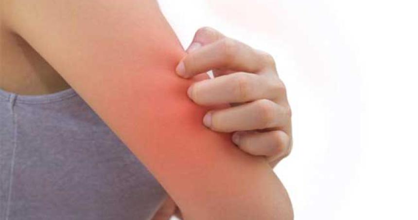 Dermatitis Atoacutepica- de queacute se trata la enfermedad de la piel que afecta a 1 de cada 10 argentinos
