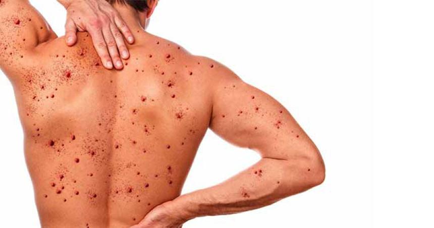 Viruela del mono- recomendaciones y prevencioacuten
