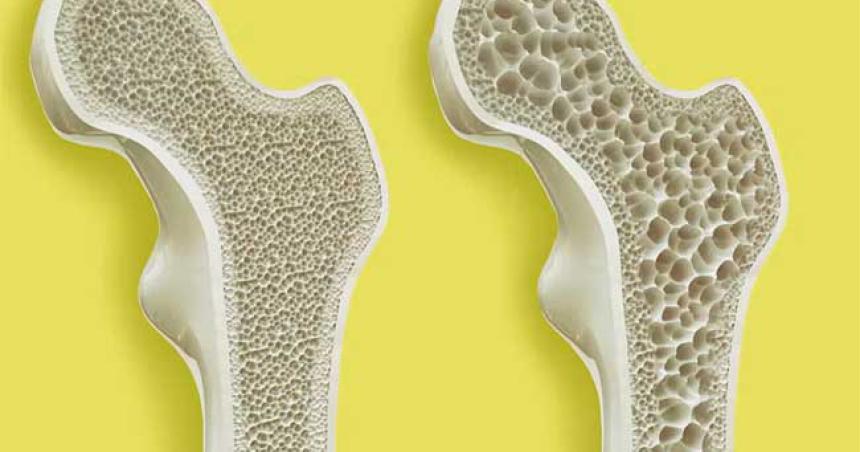 Osteoporosis- causas siacutentomas y tratamiento
