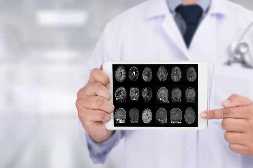 Detectan un segundo caso de una persona resistente al Alzheimer