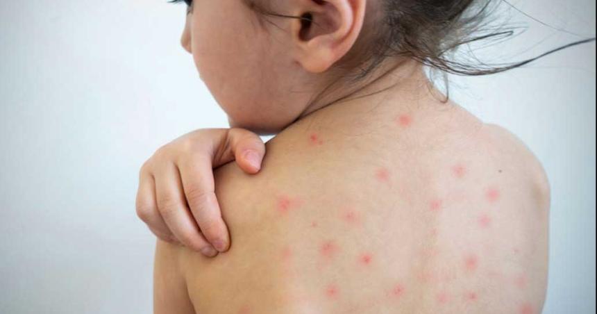 Se confirmoacute un caso de sarampioacuten en CABA y alertan por la baja vacunacioacuten