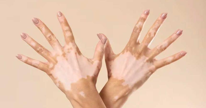 Vitiligo- claves sobre esta condicioacuten que afecta la pigmentacioacuten de la piel
