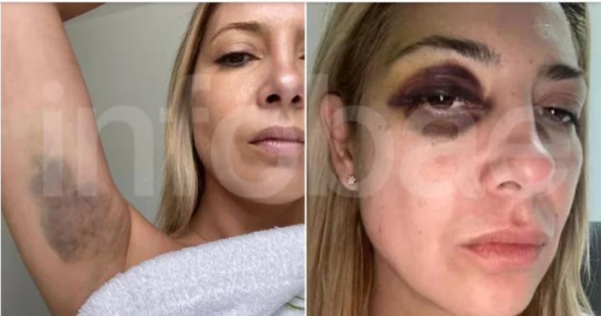 Se filtraron las fotos de Fabiola Yantildeez golpeada por Alberto Fernaacutendez