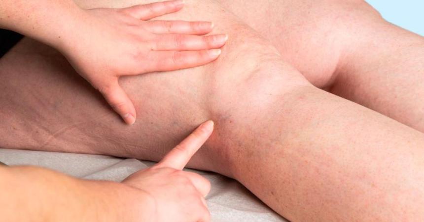 iquestPor queacute las vaacuterices empeoran en verano