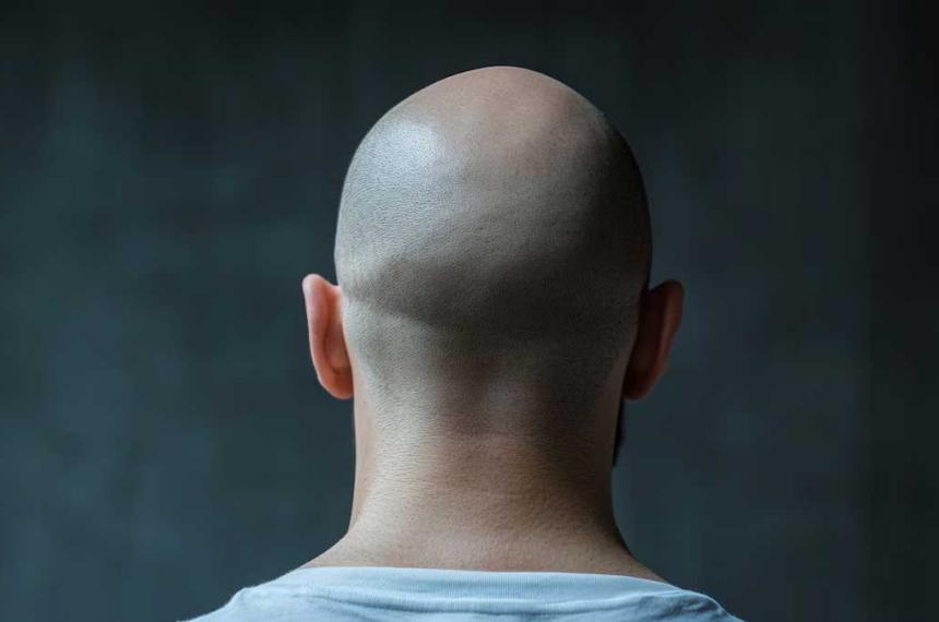 El compuesto natural que podriacutea prevenir la calvicie seguacuten un nuevo estudio