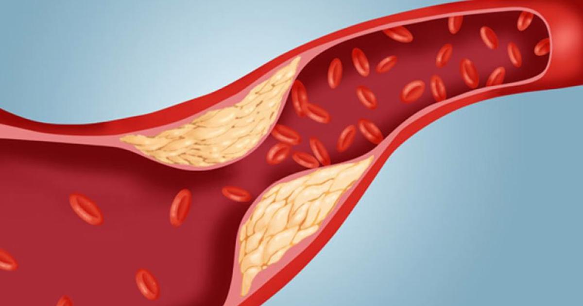 El colesterol amplifica el riesgo cardiovascular en pacientes diabeacuteticos