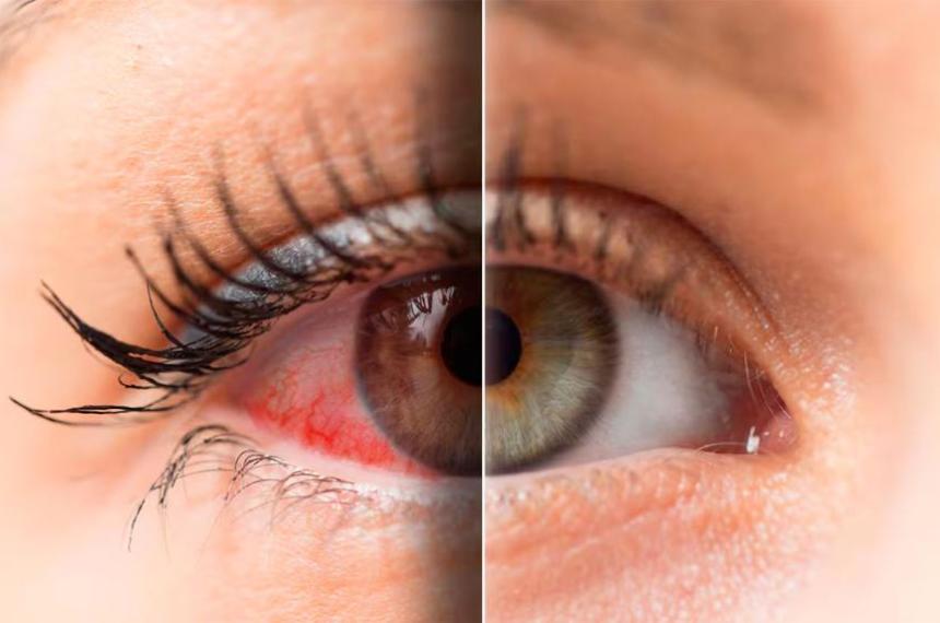 Un descubrimiento celular podriacutea cambiar el tratamiento del ojo seco