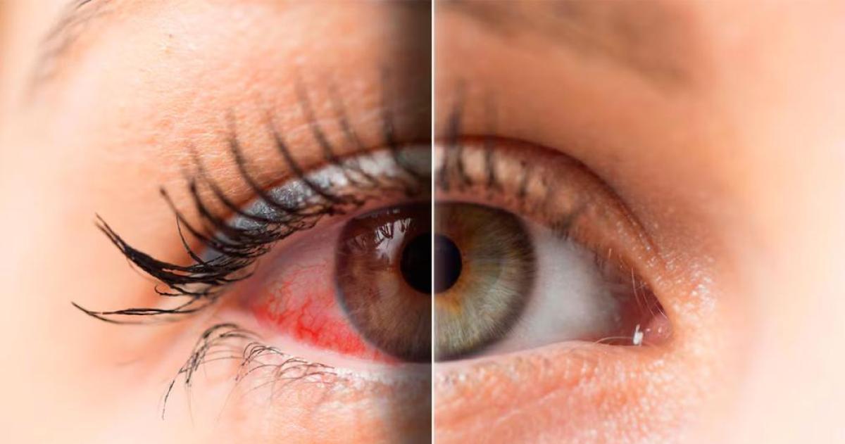 Un descubrimiento celular podriacutea cambiar el tratamiento del ojo seco