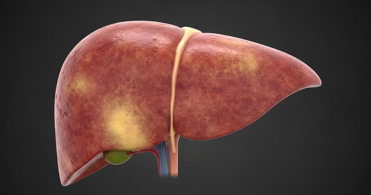 La enfermedad por hígado graso afecta a cerca del 25-en-porciento- de la población mundial especialmente asociada a obesidad y diabetes tipo 2