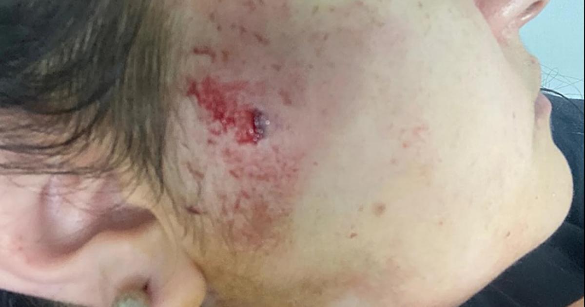 La joven sufrió una herida en la cabeza