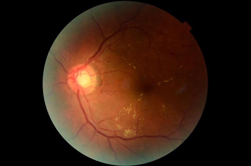 Una retina procesada a través de Retinar