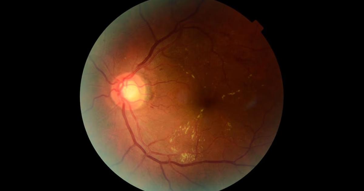 Una retina procesada a través de Retinar
