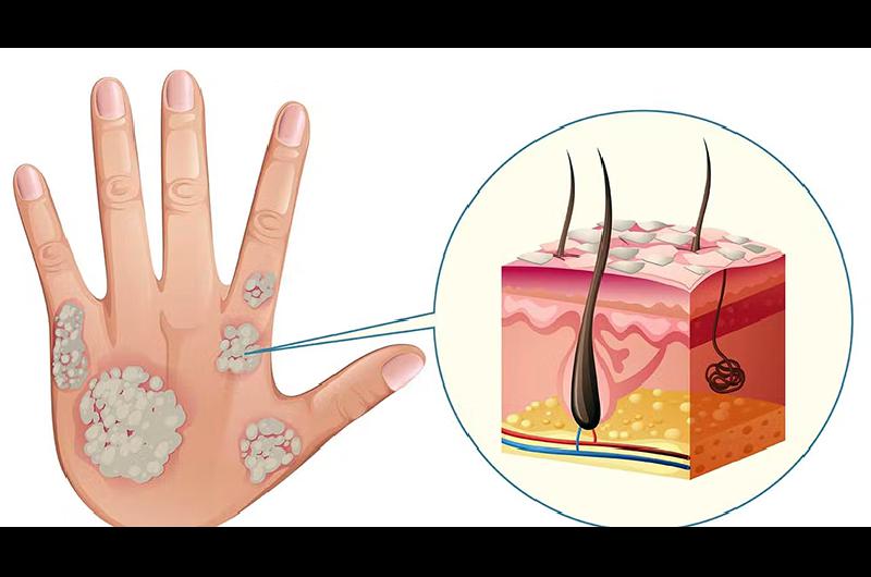 psoriasis a