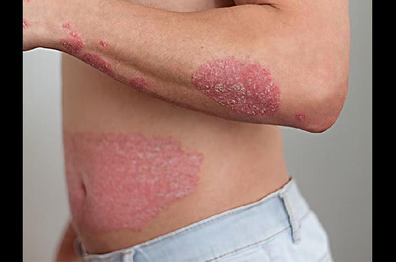 psoriasis b