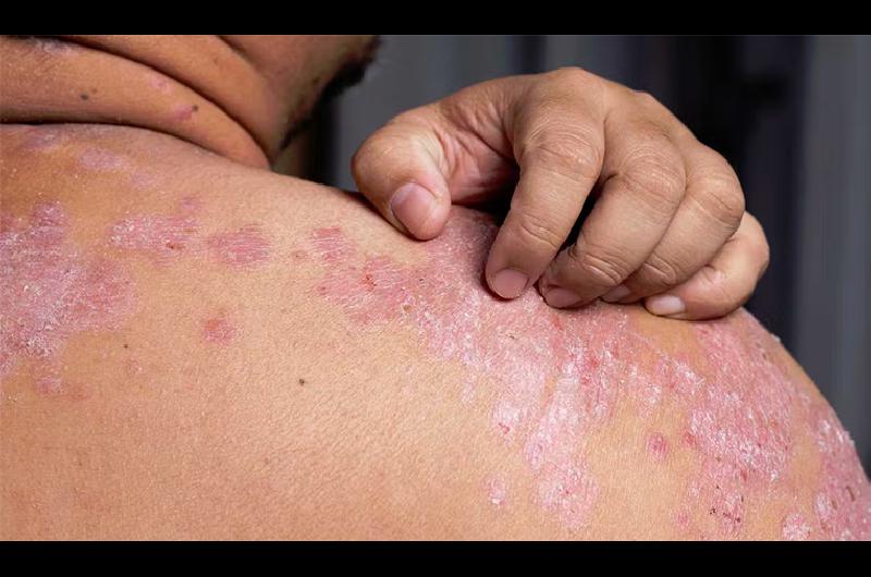 psoriasis d