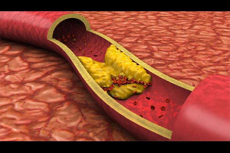 ateroesclerosis a